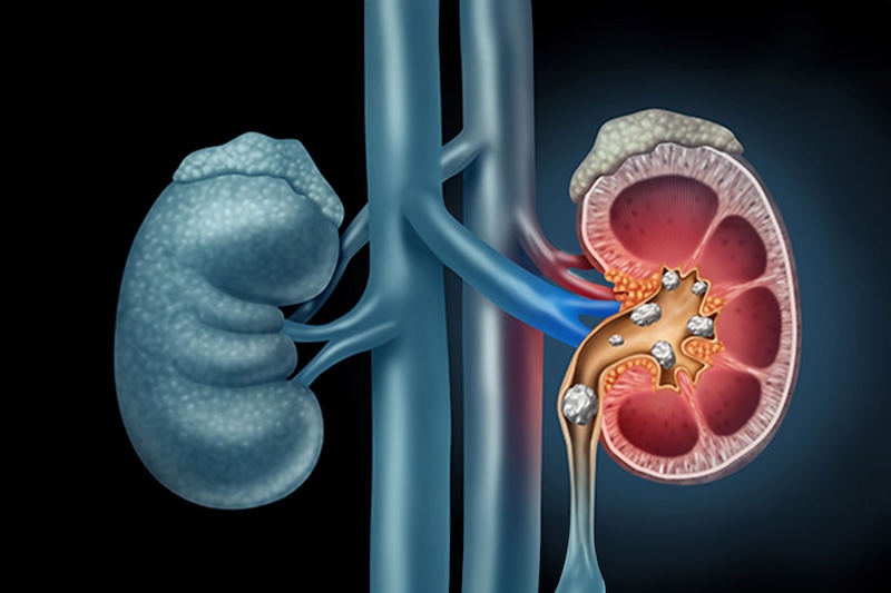 Cáculos Urinários - Dr. Emanuel Veras - Urologia e Cirurgia Robótica