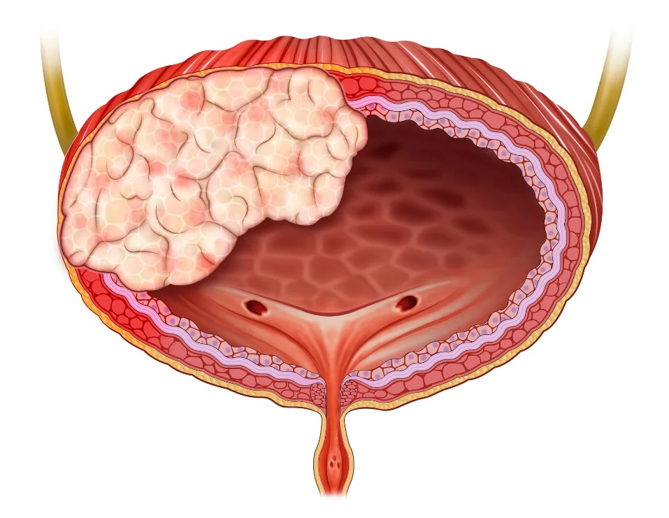 Câncer de Bexiga - Dr. Emanuel Veras - Urologia e Cirurgia Robótica