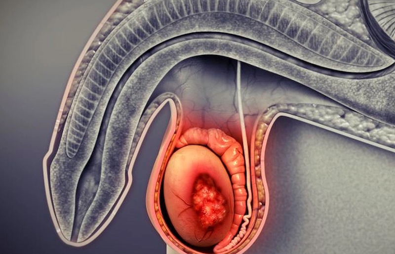 Câncer de testículo | Dr. Emanuel Veras - Urologia e Cirurgia Robótica
