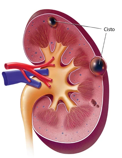 Cisto nos Rins | Dr. Emanuel Veras - Urologia e Cirurgia Robótica