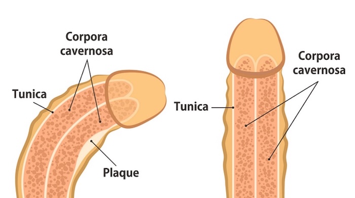 Doença de Peyronie | Dr. Emanuel Veras - Urologia e Cirurgia Robótica