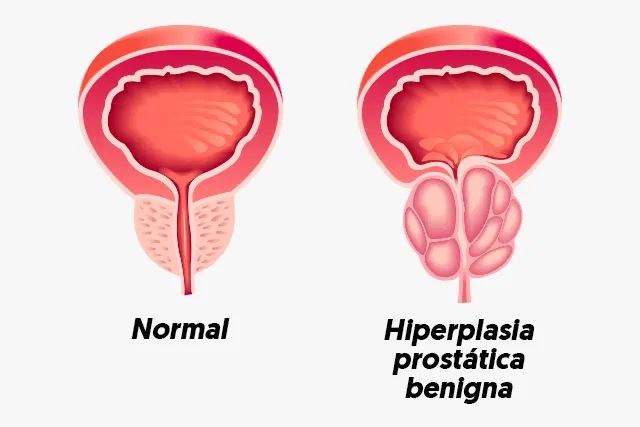HPB (Hiperplasia prostática benigna) | Dr. Emanuel Veras - Urologia e Cirurgia Robótica